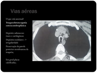 Vias aéreas
O que está anormal?
Traqueobroncopatia
osteocondroplásica


Depósito submucoso
ósseo e cartilaginoso
Depósitos nodulares ->
irregularidade
Preservação da parede
posterior membranosa da
traquéia;


Em geral placas
calcificadas;
 