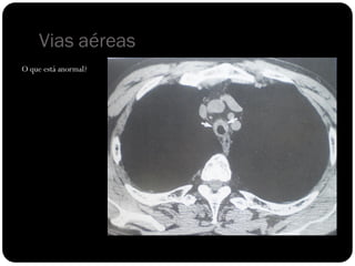 Vias aéreas
O que está anormal?
 