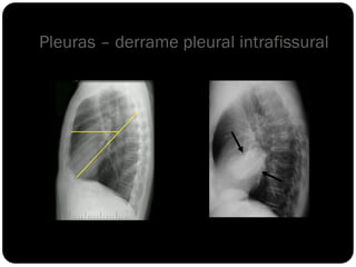 Pleuras – derrame pleural intrafissural
 