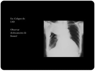 Ex: Colapso do
LSD


Observar
deslocamento de
fissura!
 