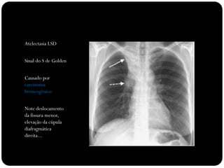 Atelectasia LSD


Sinal do S de Golden


Causado por
carcinoma
broncogênico


Note deslocamento
da fissura menor,
elevação da cúpula
diafragmática
direita...
 