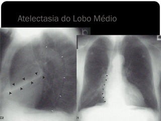 Atelectasia do Lobo Médio
 