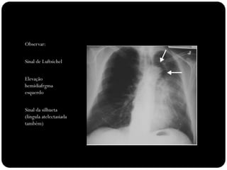 Observar:


Sinal de Luftsichel


Elevação
hemidiafrgma
esquerdo


Sinal da silhueta
(língula atelectasiada
também)
 