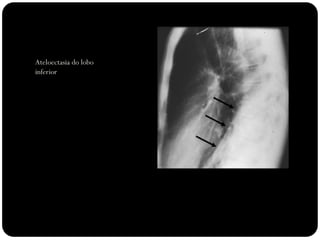 Ateloectasia do lobo
inferior esquerdo
 