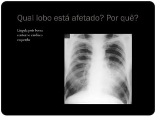 Qual lobo está afetado? Por quê?
Língula pois borra
contorno cardíaco
esquerdo
 