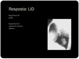 Resposta: LID
Importância do
perfil;


Importância da
ausência do sinal da
silhueta;
 