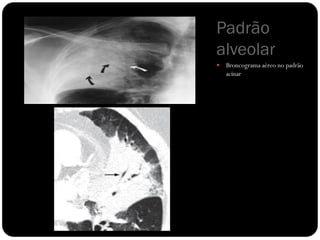 Padrão
alveolar
 Broncograma aéreo no padrão
acinar
 