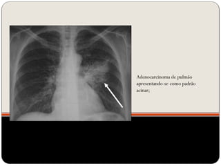 Adenocarcinoma de pulmão
apresentando-se como padrão
acinar;
 
