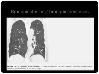 Bronquiectasias / bronquioloectasias
 