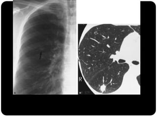 Pequeno nódulo no pulmão direito
 