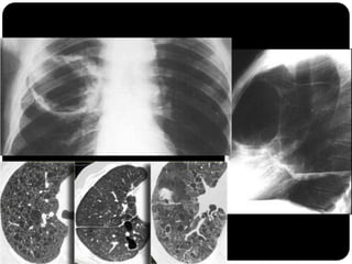 Bolhas de enfisema avançado
 