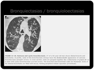 Bronquiectasias / bronquioloectasias
 