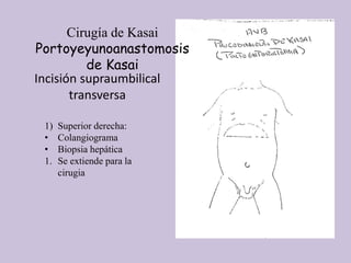 Incisión supraumbilical
transversa
1) Superior derecha:
• Colangiograma
• Biopsia hepática
1. Se extiende para la
cirugia
Cirugía de Kasai
Portoyeyunoanastomosis
de Kasai
 