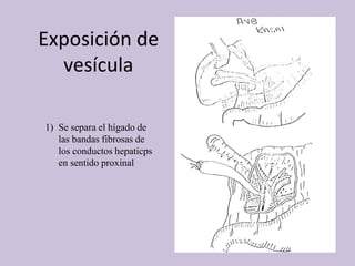 Exposición de
vesícula
1) Se separa el hígado de
las bandas fibrosas de
los conductos hepaticps
en sentido proxinal
 