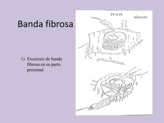 Banda fibrosa
1) Exceresis de banda
fibrosa en su parte
proximal
 