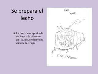 Se prepara el
lecho
1) La exceresis es profunda
de 3mm y de diámetro
de 1 a 2cm, se determina
durante la cirugia
 