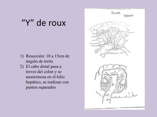 “Y” de roux
1) Resección: 10 a 15cm de
ángulo de treitz
2) El cabo distal pasa a
treves del colon y se
anastomosa en el hilio
hepático, se realizan con
puntos separados
 