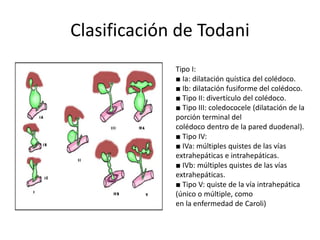 Clasificación de Todani
Tipo I:
■ Ia: dilatación quística del colédoco.
■ Ib: dilatación fusiforme del colédoco.
■ Tipo II: divertículo del colédoco.
■ Tipo III: coledococele (dilatación de la
porción terminal del
colédoco dentro de la pared duodenal).
■ Tipo IV:
■ IVa: múltiples quistes de las vías
extrahepáticas e intrahepáticas.
■ IVb: múltiples quistes de las vías
extrahepáticas.
■ Tipo V: quiste de la vía intrahepática
(único o múltiple, como
en la enfermedad de Caroli)
 