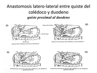 Anastomosis latero-lateral entre quiste del
colédoco y duodeno
quiste proximal al duodeno
 