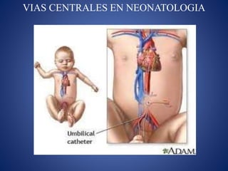 VIAS CENTRALES EN NEONATOLOGIA
 