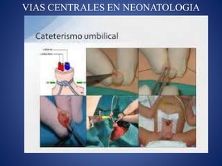 VIAS CENTRALES EN NEONATOLOGIA
 