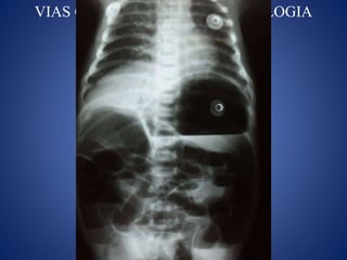 VIAS CENTRALES EN NEONATOLOGIA
 