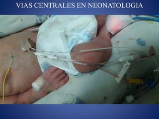 VIAS CENTRALES EN NEONATOLOGIA
 