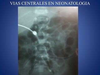 VIAS CENTRALES EN NEONATOLOGIA
 