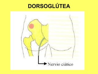 DORSOGLÚTEA
  GLÚTEA
 