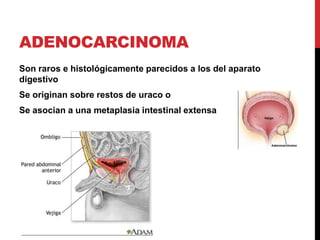 ADENOCARCINOMA
Son raros e histológicamente parecidos a los del aparato
digestivo
Se originan sobre restos de uraco o
Se asocian a una metaplasia intestinal extensa

 
