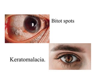 Bitot spots
Keratomalacia.
 