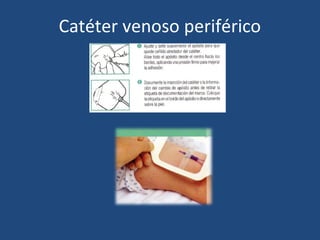 Catéter venoso periférico
 