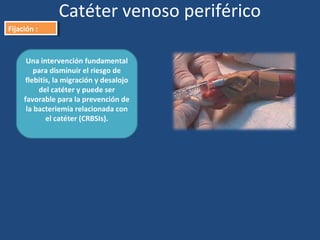 Una intervención fundamental
para disminuir el riesgo de
flebitis, la migración y desalojo
del catéter y puede ser
favorable para la prevención de
la bacteriemia relacionada con
el catéter (CRBSIs).
Catéter venoso periférico
Fijación :
Fijación :
 