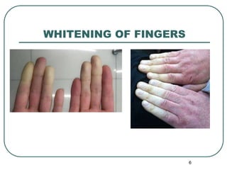 Picture of Anxiety Shaking, Trembling, Vibrating, Tremors Symptoms