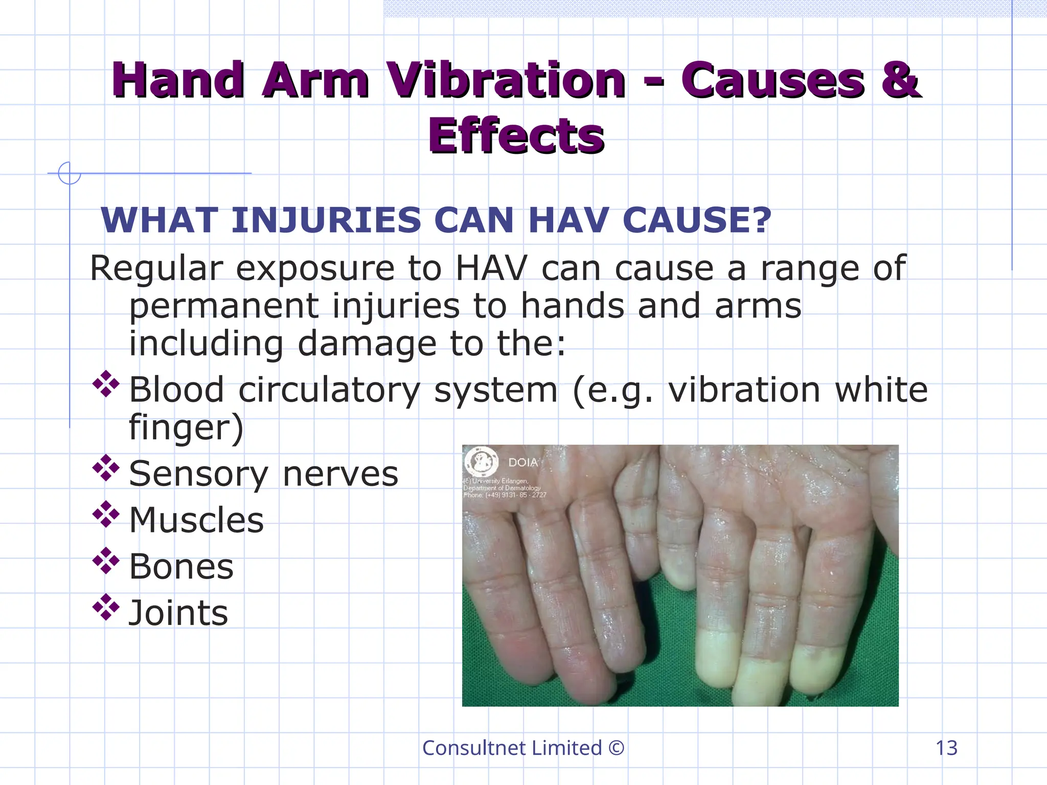Consultnet Limited © 13
Hand Arm Vibration - Causes &
Hand Arm Vibration - Causes &
Effects
Effects
WHAT INJURIES CAN HAV CAUSE?
Regular exposure to HAV can cause a range of
permanent injuries to hands and arms
including damage to the:
Blood circulatory system (e.g. vibration white
finger)
Sensory nerves
Muscles
Bones
Joints
 