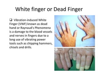 White finger or Dead Finger
 Vibration-induced White
Finger (VWF) known as dead
hand or Raynaud's Phenomena
is a damage to the blood vessels
and nerves in fingers due to a
long use of vibrating power
tools such as chipping hammers,
chisels and drills.
 