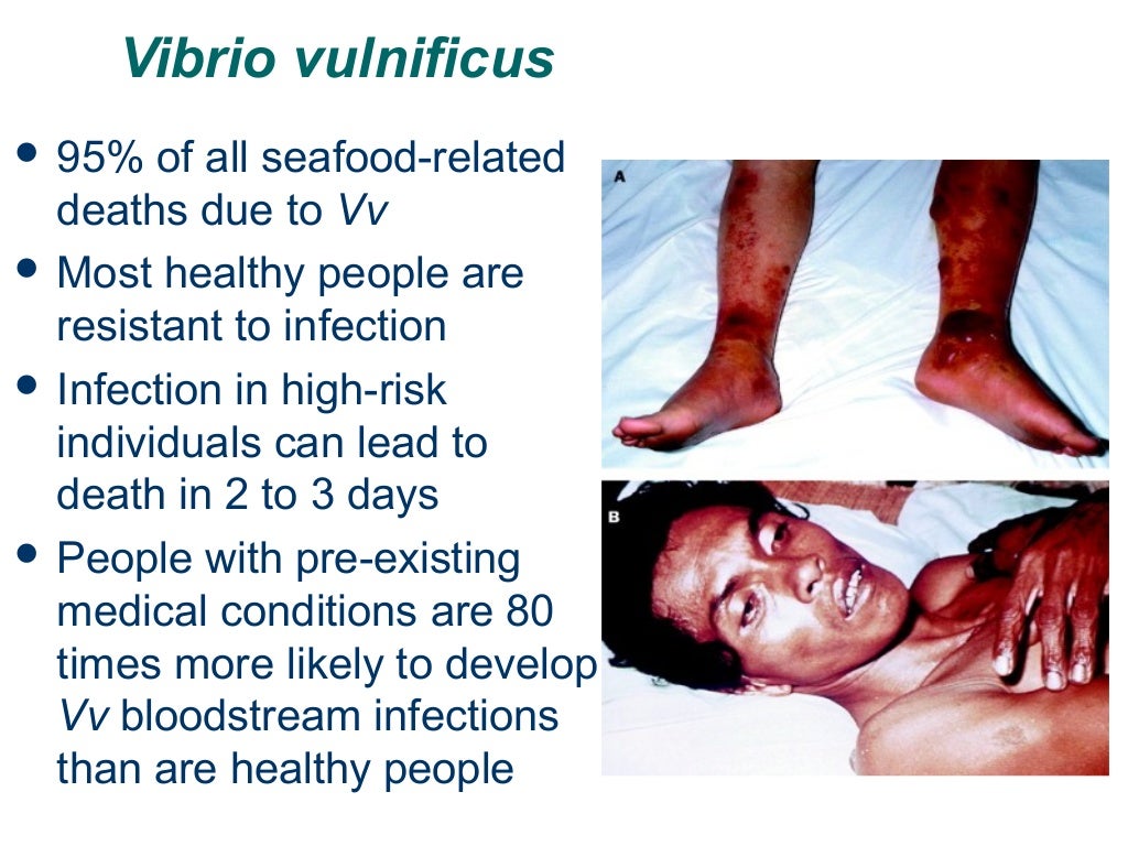 Vibrio vulnificus