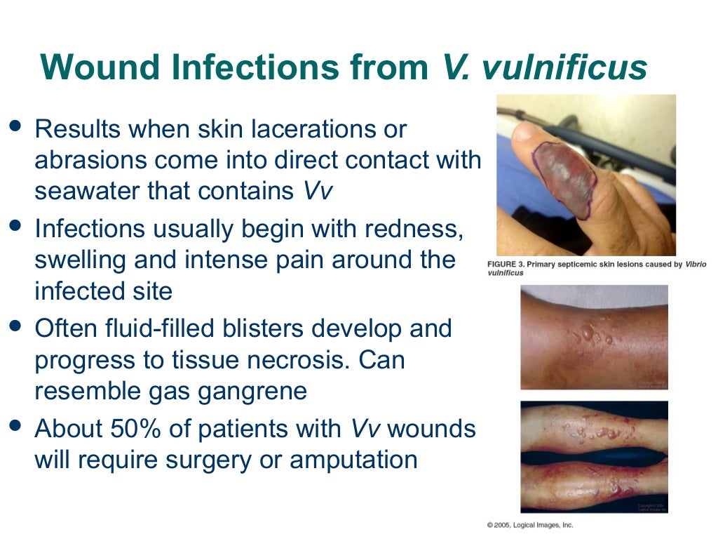 Vibrio vulnificus
