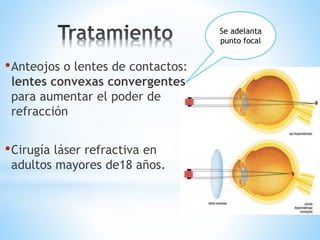 •Anteojos o lentes de contactos:
lentes convexas convergentes
para aumentar el poder de
refracción
•Cirugía láser refractiva en
adultos mayores de18 años.
Se adelanta
punto focal
 