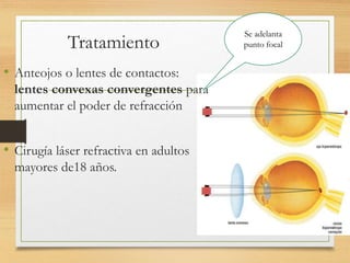 Tratamiento
• Anteojos o lentes de contactos:
lentes convexas convergentes para
aumentar el poder de refracción
• Cirugía láser refractiva en adultos
mayores de18 años.
Se adelanta
punto focal
 