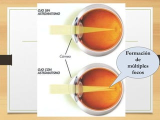 Formación
de
múltiples
focos
 