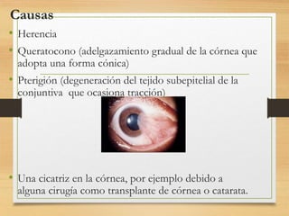 Causas
• Herencia
• Queratocono (adelgazamiento gradual de la córnea que
adopta una forma cónica)
• Pterigión (degeneración del tejido subepitelial de la
conjuntiva que ocasiona tracción)
• Una cicatriz en la córnea, por ejemplo debido a
alguna cirugía como transplante de córnea o catarata.
 