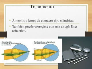 Tratamiento
• Anteojos y lentes de contacto tipo cilindricas
• También puede corregirse con una cirugía láser
refractivo.
 