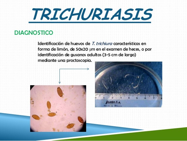 Resultado de imagen para Trichuris trichiura DIAGNOSTICO
