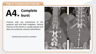 Type A. Compression Injuries
Complete
burst
A4.
Fracture with any involvement of the
posterior wall and both endplates. Vertical
fracture of the lamina is usually present and
does not constitute a tension band failure.
Estallamiento total de la vertebra
 