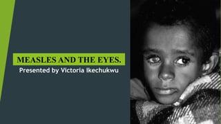 MEASLES AND THE EYES.
Presented by Victoria Ikechukwu
 