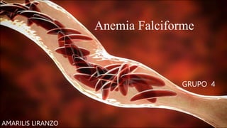 Anemia Falciforme
GRUPO 4
AMARILIS LIRANZO
 