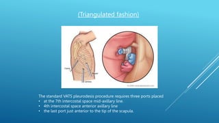 The standard VATS pleurodesis procedure requires three ports placed
• at the 7th intercostal space mid-axillary line.
• 4th intercostal space anterior axillary line
• the last port just anterior to the tip of the scapula.
(Triangulated fashion)
 