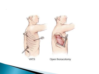 Video assisted thoracic surgery (vats) | PPTX