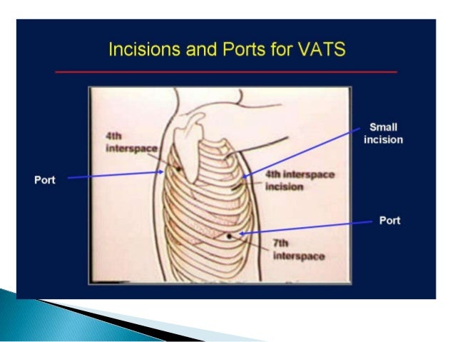 Video Assisted Thoracic Surgery vats 